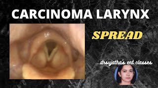 088Spread of Cancer Larynx  Part 12 carcinoma larynx [upl. by Annoiek]