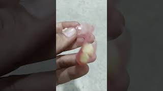 Flexible Removable Partial Denture 😁😁😁flexible dentures dentalartbyhaider [upl. by Dan]