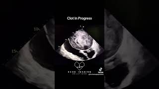 Severe Mitral Stenosis amp Atrial Thrombus Formation echocardiography echocardiogram cardiology [upl. by Odrahcir]