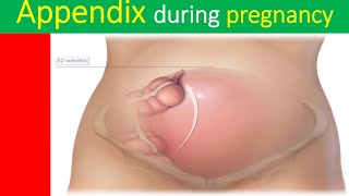 Acute appendicitis during pregnancy clinical features diagnosis of appendicitis during pregnancy [upl. by Ecinev]