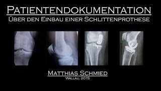 Patientendokumentation über den Einbau einer Schlittenprothese im Knie [upl. by Ahsitneuq]