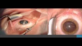 Refractive lens exchange with multifocal lens implantation [upl. by Tnecniv]