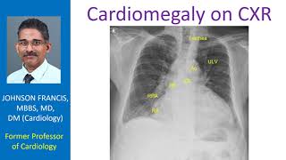 Cardiomegaly on CXR [upl. by Zel]