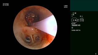 Bronchoscopic Recanalisation  Massive Hemoptysis  Renal Cell Cancer  Airway Metastasis [upl. by Poucher]