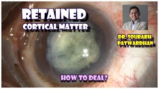 83 retained Cortical cortex matter behind IOL Dr Sourabh Patwardhan How to deal [upl. by Eimmac454]