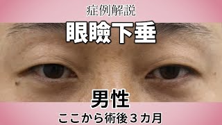 男性の眼瞼下垂手術。手術後3か月の症例解説。名古屋こいずみ形成クリニック [upl. by Sarkaria]