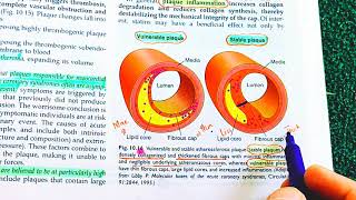 Atherosclerosis Robbins Pathology Atherosclerosis vs Arteriosclerosis  Atherosclerosis Pathology [upl. by Ahsenad]