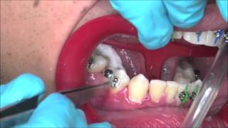 ¿Cómo se Colocan los Brackets  OrtoDental México [upl. by Arym767]