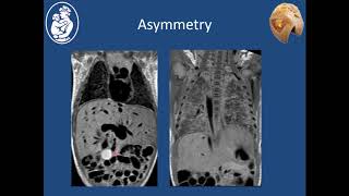 Heterotaxy Syndromes  Stephen Sanders MD [upl. by Noam]