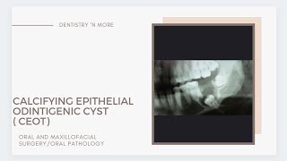 adenomatoid odontogenic tumor [upl. by Stevenson]