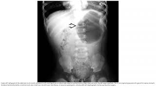 Gastric Volvulus Imaging [upl. by Eslehc]