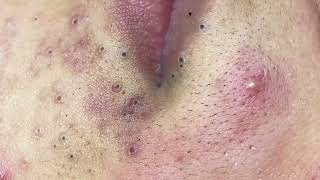 Big blackheads whiteheads pimple popping  Nhat Bang Acne Treatment  Chuyen Nguyen Spa 14 [upl. by Nalor]