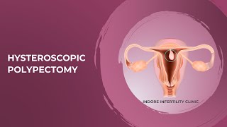 Removal of Uterine Polyp  Hysteroscopic Polypectomy How is it done  Removal of Polyp in Uterus [upl. by Opiuuk107]