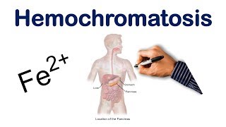 Hemochromatosis  USMLE COMLEX NCLEX [upl. by Alebasi]