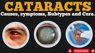 5 Surprising Causes and Treatments for Cataracts Revealed [upl. by Thain]