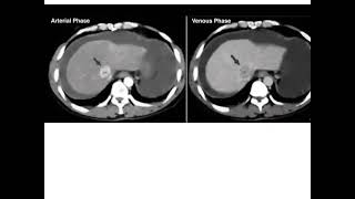 Dr Baki biliary zoom 03 surgery made easy for undergraduate students [upl. by Otilegna]