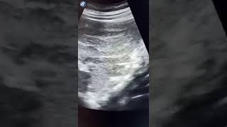 Intussusception [upl. by Cam]