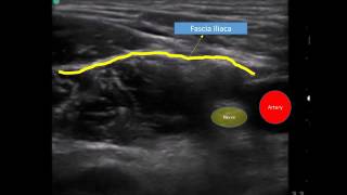 Ultrasound guided fascia iliaca compartment block  labelled [upl. by Aicelef]