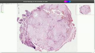 Pleomorphic Adenoma  Histopathology [upl. by Ursal]