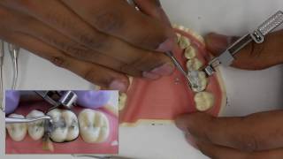 Amalgam Fill Restoration Walkthrough tutorial  Simulation Clinic Demonstration [upl. by Gladis]