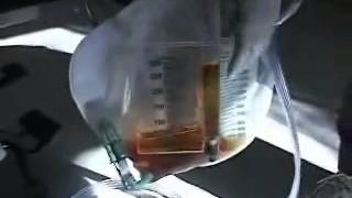 Foley Catheter Tubing and Collection Bag Free Nursing Video Lecture [upl. by Yornek939]