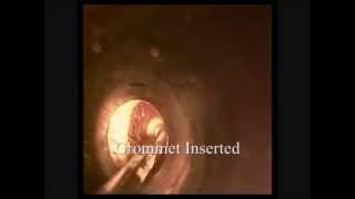 Myringotomy amp Grommet Insertion for Atelectasis  Hearing Loss [upl. by Nylasej45]