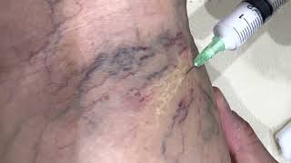 Sclerotherapy for spider veins [upl. by Llennej]