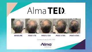 Alma TED  Hair loss solution  Another Look Hair Institute [upl. by Higginson]