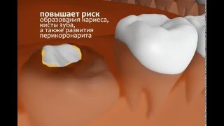 Прорезывание зубов Прорезывание зуба мудрости [upl. by Ahsinawt]