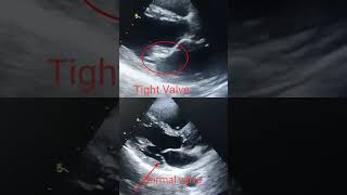 Tight  Stenosed Heart valve in Echo l सिकुड़ा हुआ वाल्व एको में कैसा दिखता है shorts echo [upl. by Joanna]