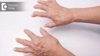 Signs and symptoms of Rheumatoid Arthritis  Dr Prashanth Jain [upl. by Afatsom]