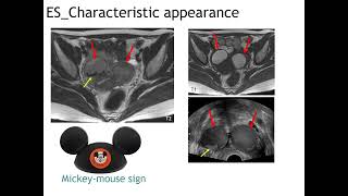 Imaging of endometriosis and adenomyosisKRadiology Tutorial [upl. by Yelha]