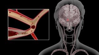 Carotid Dissection [upl. by Adala]