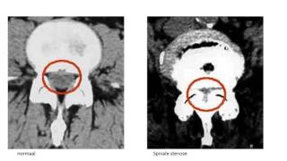 spinale stenose [upl. by Arsi]