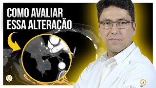 CÂNCER DE MAMA ou CANCER DE PULMÃO O que observar na Tomografia [upl. by Acsisnarf410]