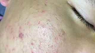 Blackheads amp Whiteheads Removal New 2024 Acne Treatment With Nhat Bang [upl. by Lehar]