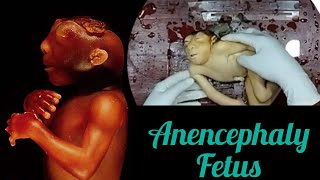 Anencephaly fetus mounting video😍👍🏻 specimen baby biopsy reels cutebaby newborn anencephaly [upl. by Dyraj]