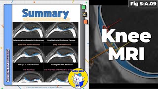 Fig 5A09 Summary of MRI Findings in Cartilage Damage [upl. by Adamik]