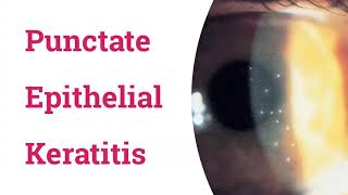 Punctate Epithelial Keratitis PEK [upl. by Xel]