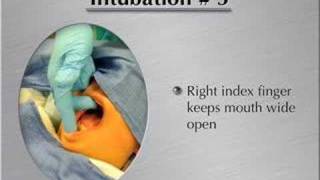 IntubationHow to perform endotracheal intubation 1 [upl. by Picco]