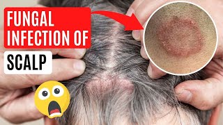 What causes Scalp Ringworm ✅ Effective Treatment Tinea Capitis [upl. by Ylenats640]