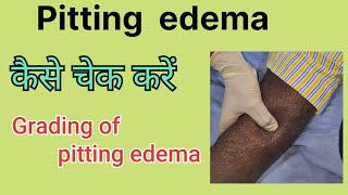 Pitting edema How to examine pitting edema Grades in pitting edema [upl. by Llekim170]