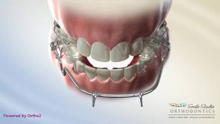 Tandem Appliance  Orthodontic Treatment [upl. by Hessler]