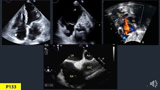 Anatomy Of Heart In Echo Part 6 Right Atrium [upl. by Freedman]