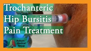 Trochanteric Hip Bursitis Pain Treatment  Auburn Medical Group [upl. by Dita956]