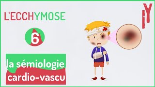 EPISODE6 sémiologie cardiovasculaire LECCHYMOSE [upl. by Eitteb]