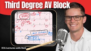 Third Degree Complete AV Block EKG  ECG Lecture [upl. by Wemolohtrab]