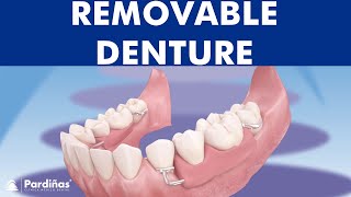 Removable partial denture © [upl. by Ttiwed]