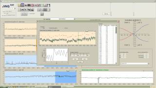 eVNG Caloric Settings [upl. by Daisy]