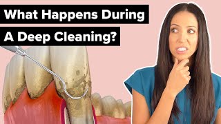 What Happens During a Deep Cleaning Procedure Scaling and Root Planing [upl. by Haduhey]